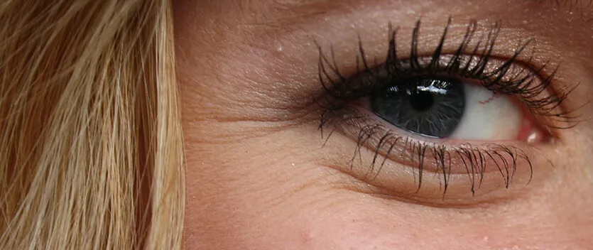 Botox: Un tratamiento poco invasivo para prevenir arrugas