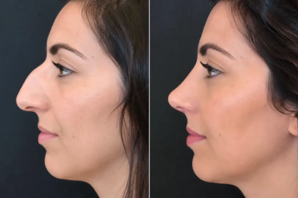 Rinoplastia en Sevilla: la cirugía que armoniza tu rostro sin cambiar quién eres