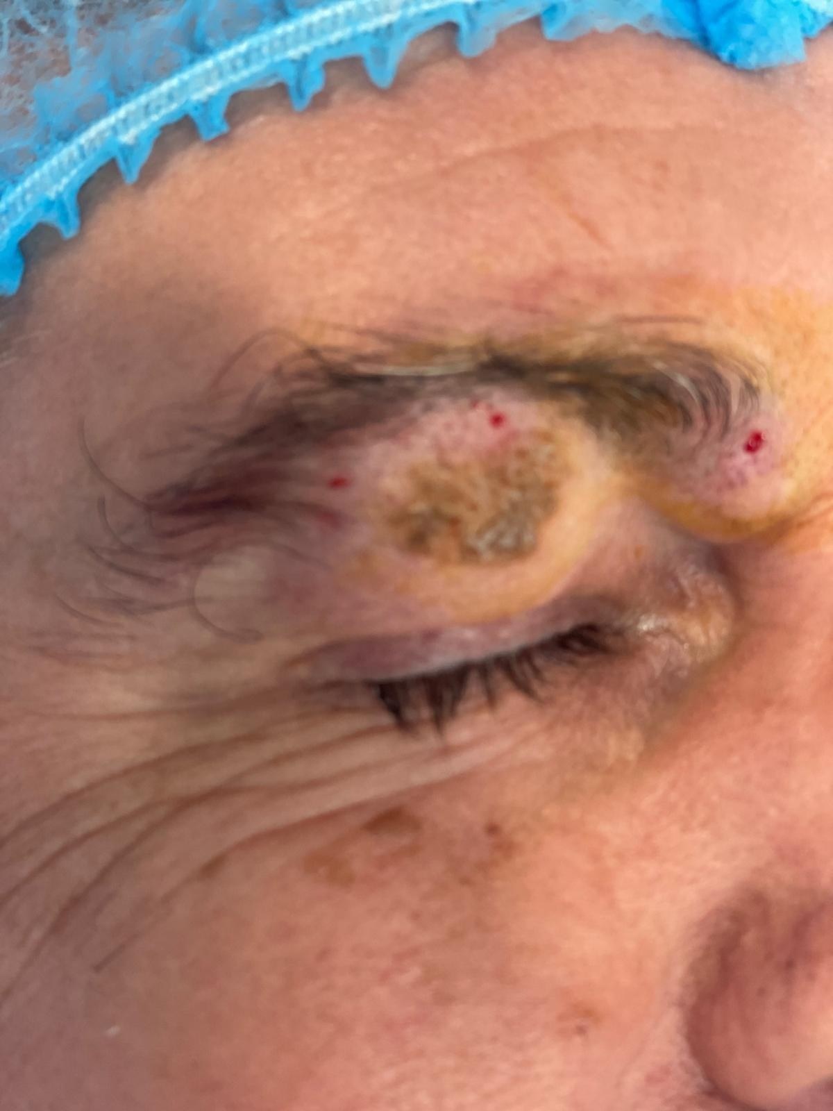Lesión facial — antes