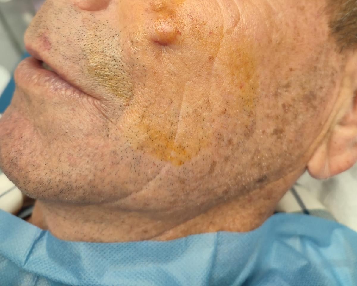 Quiste facial — antes