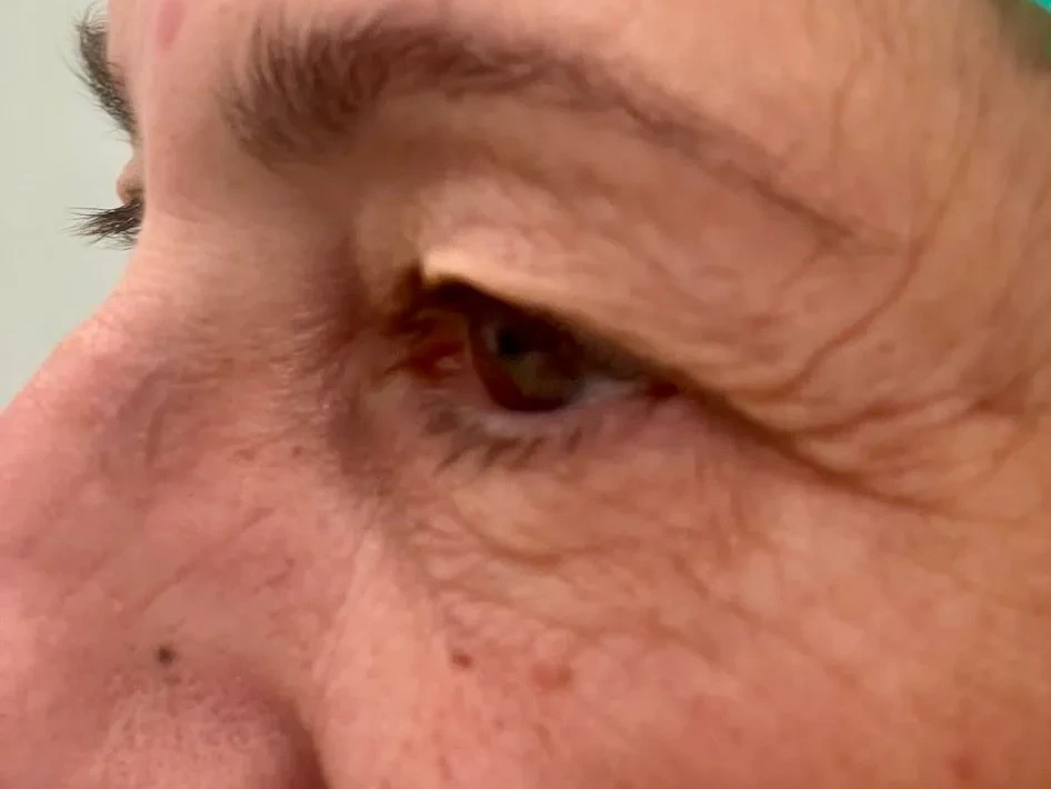Blefaroplastia — antes
