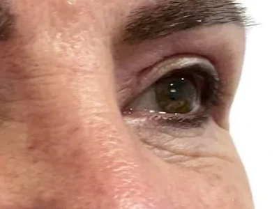 Blefaroplastia — después